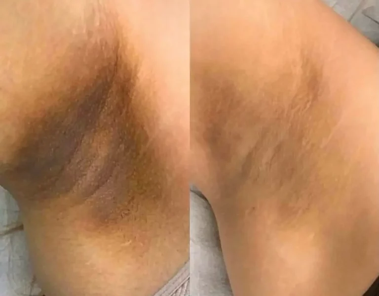 Before after biorepeel