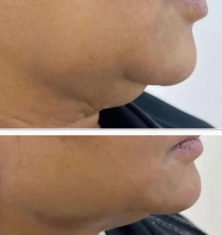 Before after double chin