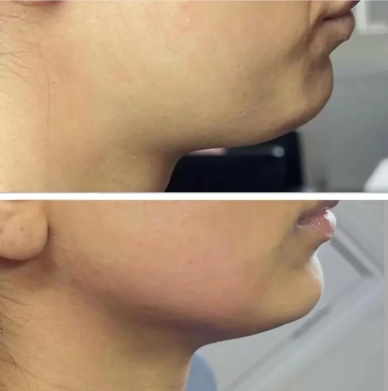 Before after double chin