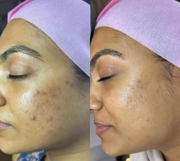 Before after microneedling