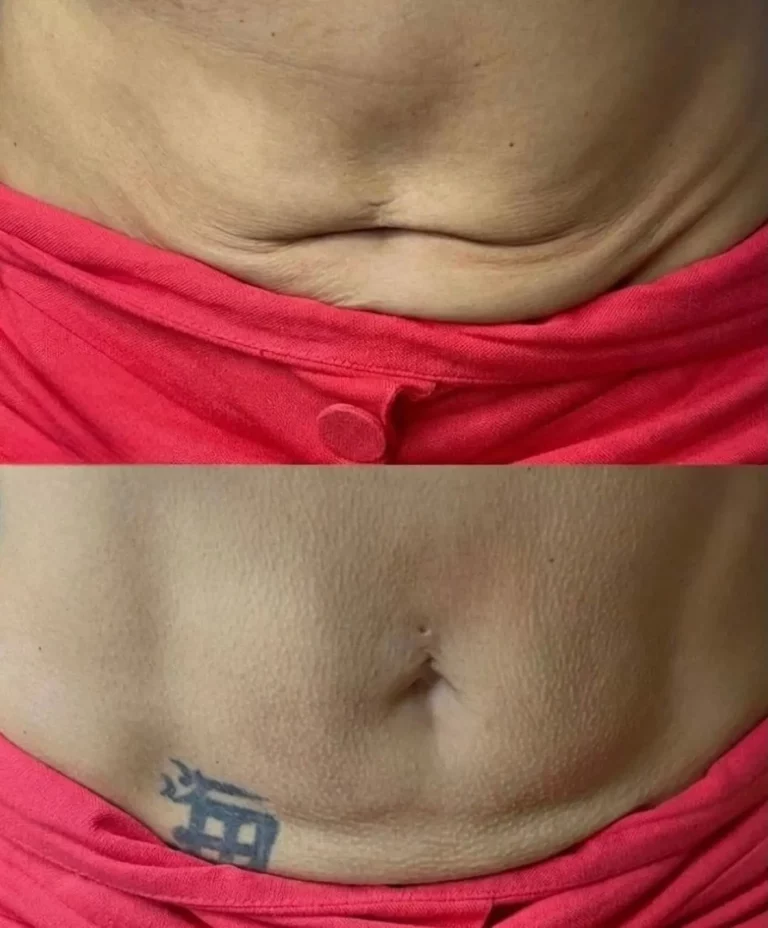 Before after radio frequency
