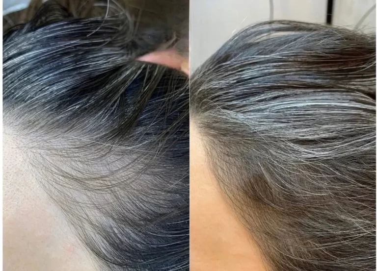Before after scalp microneedling