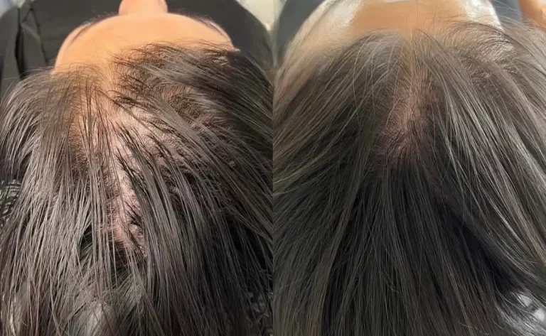 Before after scalp microneedling