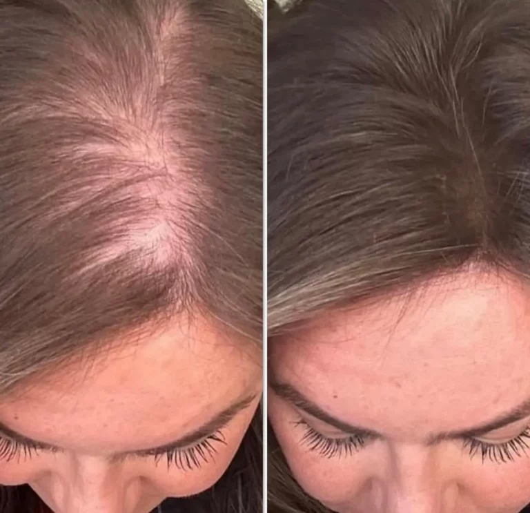 Before after scalp microneedling