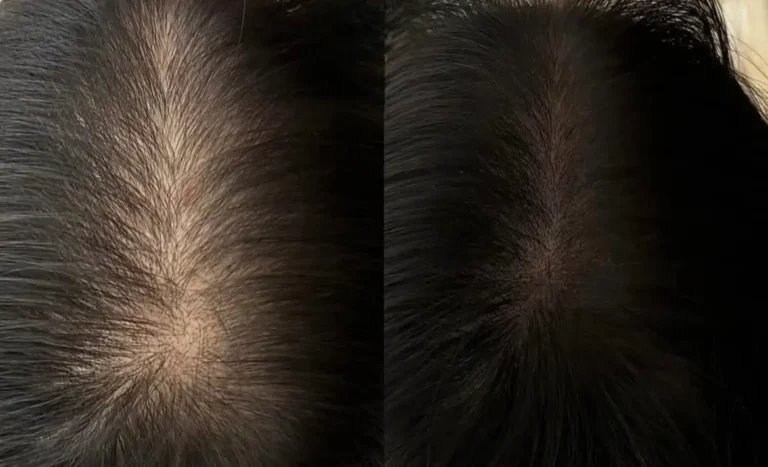 Before after scalp microneedling