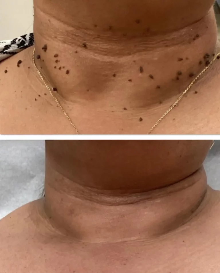 Before after skin tag