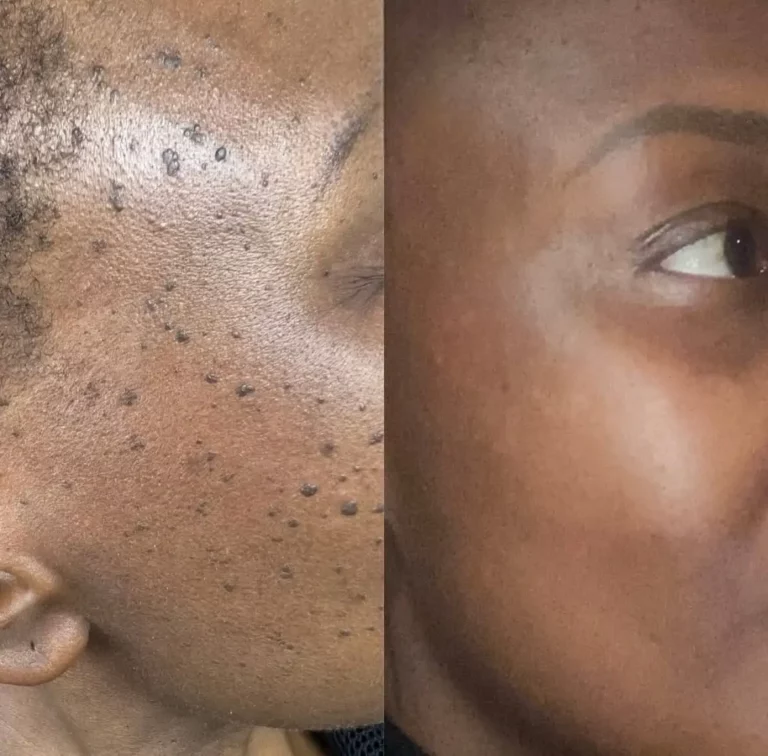 Before after skin tag