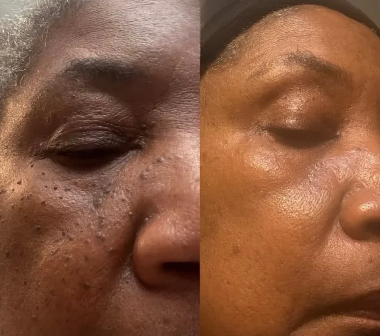 Before after skin tag