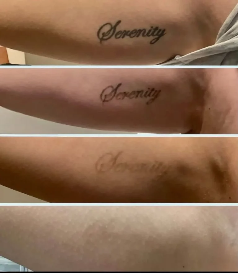 Before after tattoo