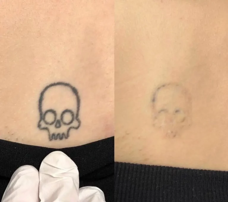 Before after tattoo