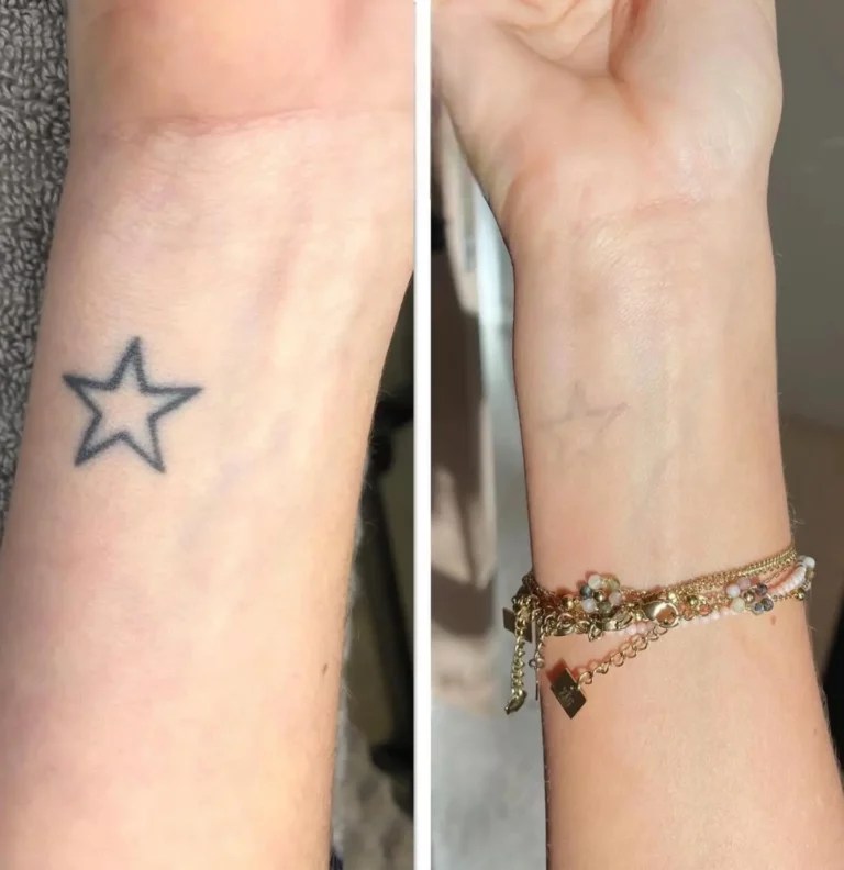 Before after tattoo