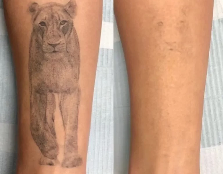 Lighter, broken down ink after laser tattoo removal.