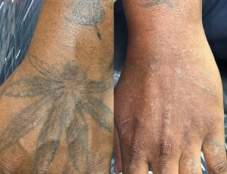 Before after tattoo